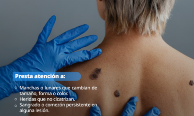 Llama IMSS Hidalgo a Usar Bloqueador Solar Para Evitar cáncer de piel