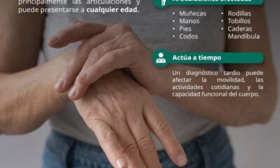 Exhorta IMSS Hidalgo a Población a Reconocer Oportunamente Síntomas de Artritis Reumatoide